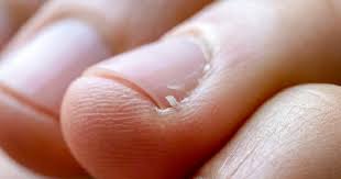 hangnail causes symptoms and treatment