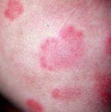 hives from household mold exposure