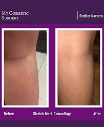 stretch mark camouflage my cosmetic