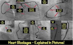 heart blockage explained with pictures