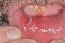 mouth ulcer inside lower lip stock