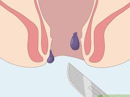 Check spelling or type a new query. 3 Ways To Treat Pregnancy Hemorrhoids Wikihow