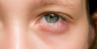 how to treat red swollen eyelid