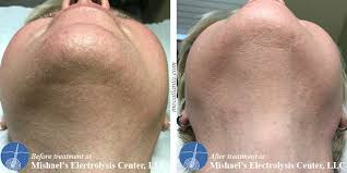 Laser hair removal can be performed on any area of the face or body in as little as 15 to 30 minutes and is faster and easier than other methods of hair removal. Before After Electrolysis Hair Removal Mishael S Electrolysis Center