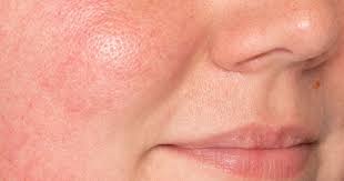 what is rosacea and how to treat it