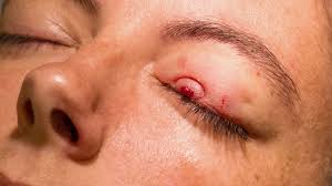 chalazion healing ses pictures and