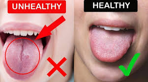Healthy Tongue Vs Unhealthy Tongue How To Read Your Tongue