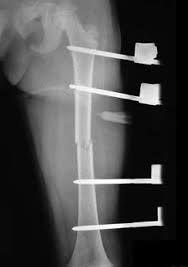fem shaft fractures pediatric