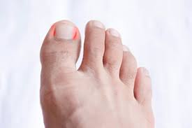 the three ses of an ingrown toenail