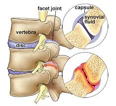 Spine &amp; Orthopedic Center - What is Facet Joint Syndrome? When pain comes from one or more facet joints, it is called facet joint syndrome. This disease is caused by degenerative changes (