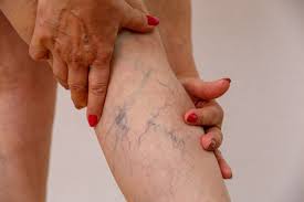 varicose veins everything you need to know