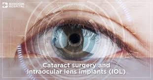 cataract surgery and intraocular lens