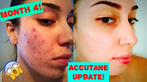 how i got rid of my acne month 4