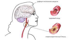 Особенности заболевания, причины возникновения, разновидности и симптомы энцефалопатии головного мозга. Sosudistaya Encefalopatiya Informaciya