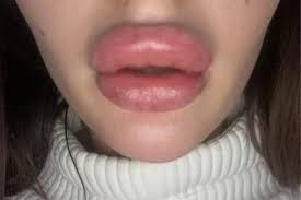 side effects of lip injections