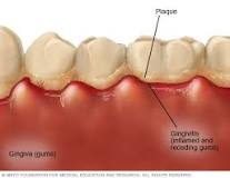 Image result for icd 10 code for gum infection