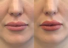 botox lip flip toronto non surgical