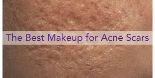 how to cover acne scars with makeup