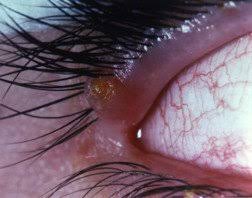 styes and chalazions guide causes