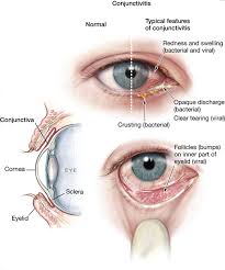 conjunctivitis precision cataract