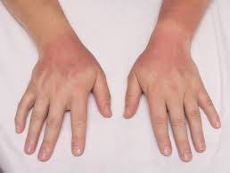 Rheumatoid Arthritis Medications Sun Exposure