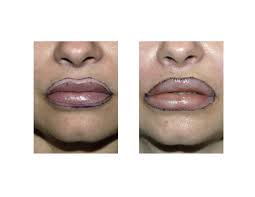 upper and lower lip vermilion