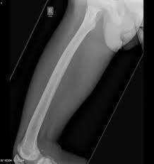 fem shaft fractures trauma