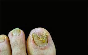 toenail fungus your shoes how long