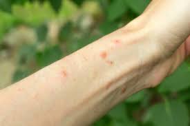 skin rash from weeds and plants