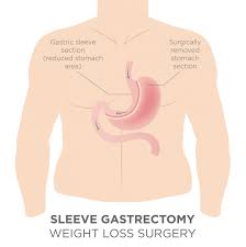 gastric sleeve vsg weight loss