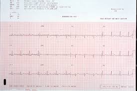 Heart And Pulse Rate Chart Ecg Electrocardiogram Electric