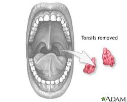 tonsillectomy medlineplus cal