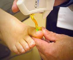 laser treatment of toenail fungus