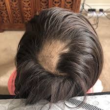 resolves alopecia areata