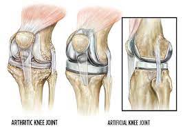 total knee replacement summit orthopedics