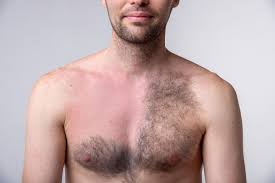 I had it on my chest and now have no folliculitis there however not sure if i want to do the same thing on my face. Common Laser Hair Removal Side Effects And How To Fix Or Prevent Them