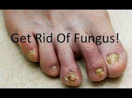 listerine for foot toenail fungus