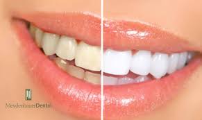 find fast teeth whitening methods in