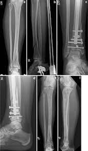 ao 43c1 distal tibia fracture