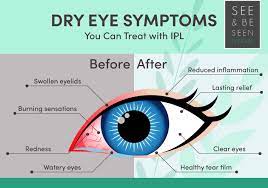 ipl treatment for dry eye how it works