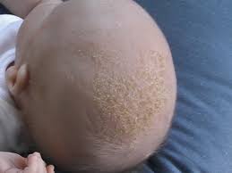 Find out what might be behind your locks loss. Cradle Cap Wikipedia