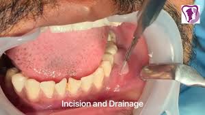 drainage of tooth abscess draining pus