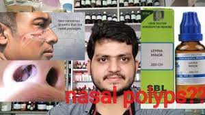 nasal polyps homeopathic cine for