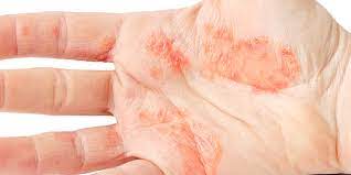 dyshidrotic eczema how to tell if your