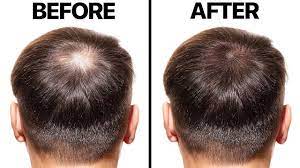 minoxidil for hair loss you