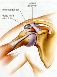 shoulder impingement syndrome pain and