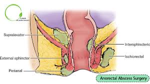 anorectal abscess surgery dr zahra