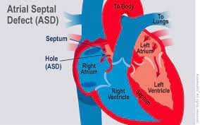 A hole in the heart is called a ventricular septal defect. Atrial Septal Defect Asd For Parents Nemours Kidshealth