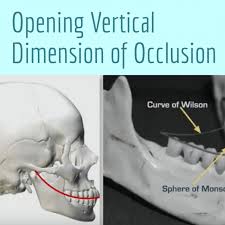 opening vertical dimension of occlusion