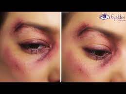 bruised black eye makeup tutorial by